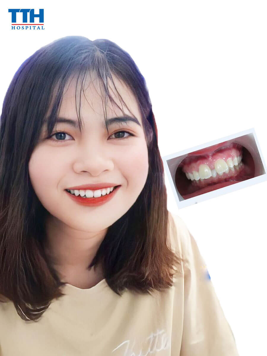 Niềng răng thưa ít đau đớn và nhanh hiệu quả nhất