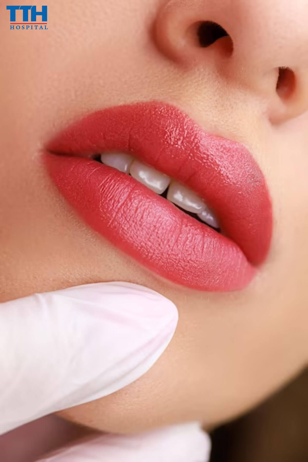 Phẫu thuật cắt môi trên khắc phục nụ cười hở lợi