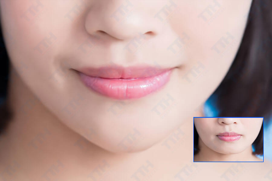 Phẫu Thuật Chỉnh Hình Xương Hai Hàm Kết Hợp Gọt Xương Góc Hàm và Tạo Hình Cằm
