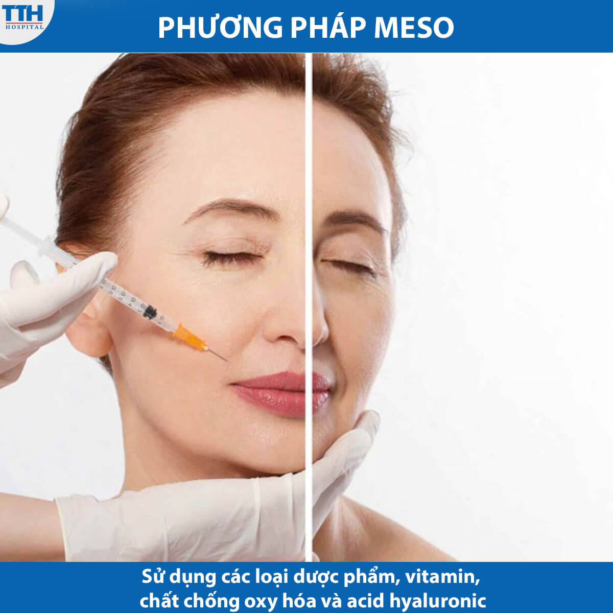 Cách thức hoạt động của trẻ hóa da Meso
