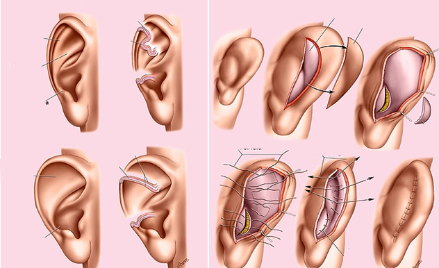 Phẫu thuật tạo hình vành tai là gì?