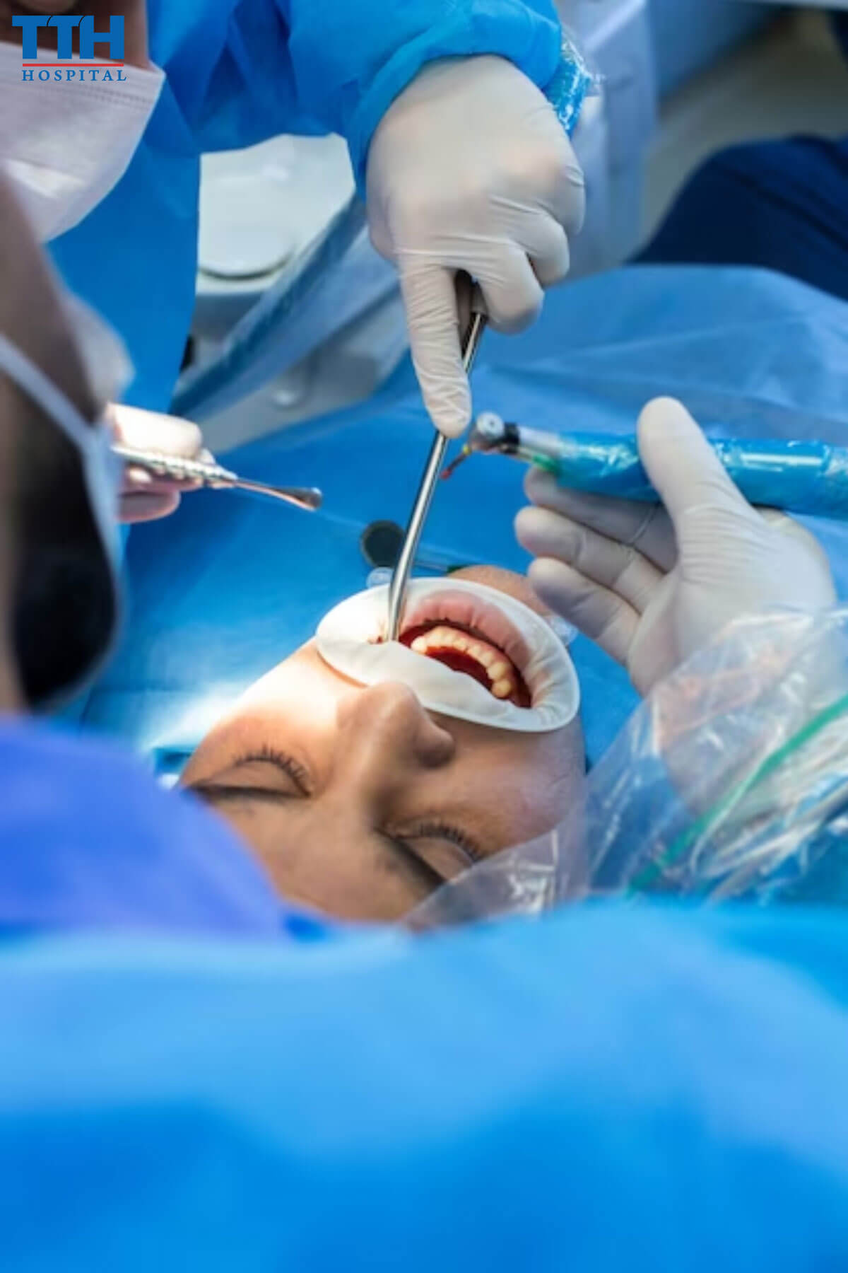 Quá Trình Nhổ Răng Khôn tại Vinh, Nghệ An