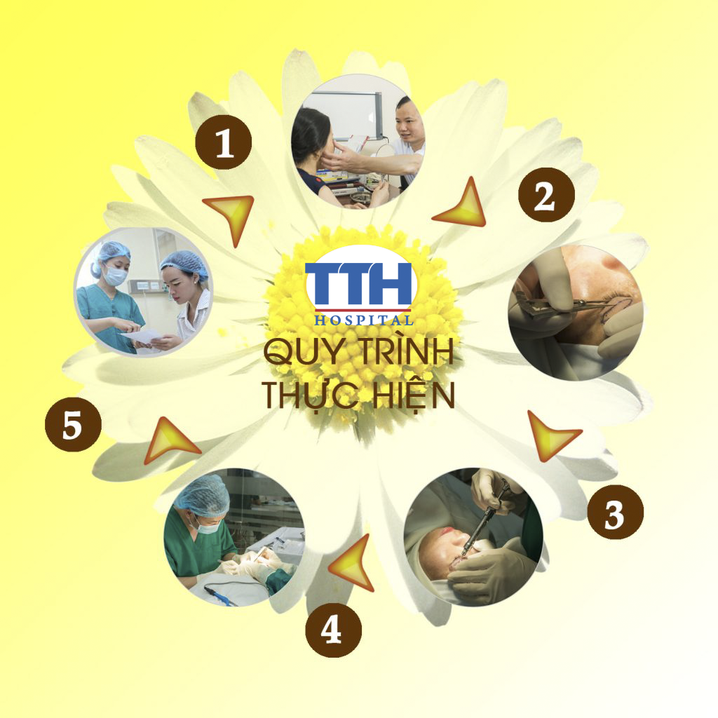 Quy trình căng chỉ nâng cung mày