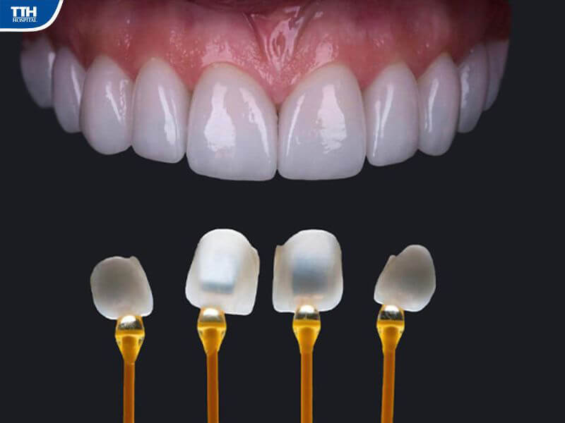 Quy trình dán sứ veneer