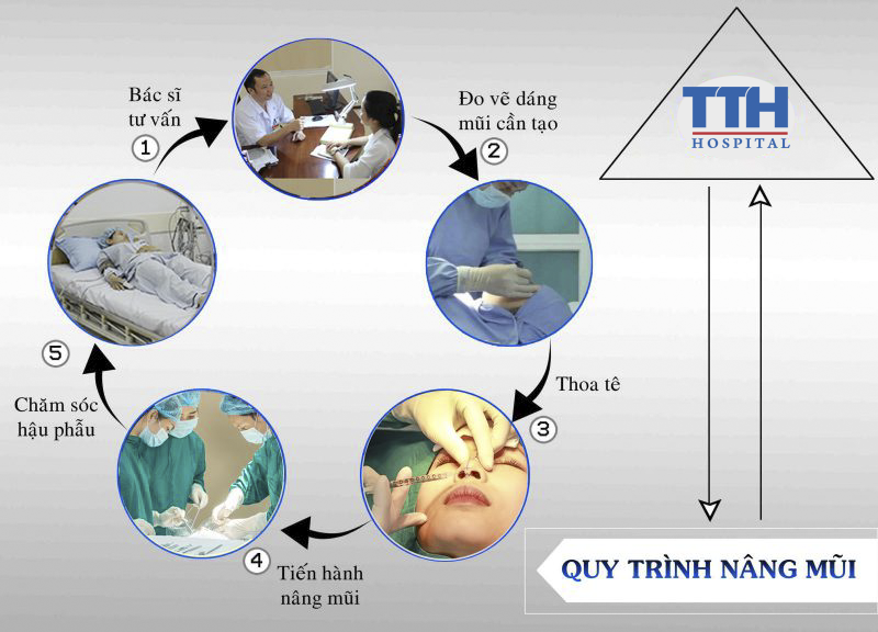 Quy trình nâng mũi cấu trúc
