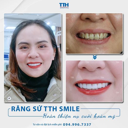 Khách hàng bọc răng sứ tại Bệnh viện Thái Thượng Hoàng