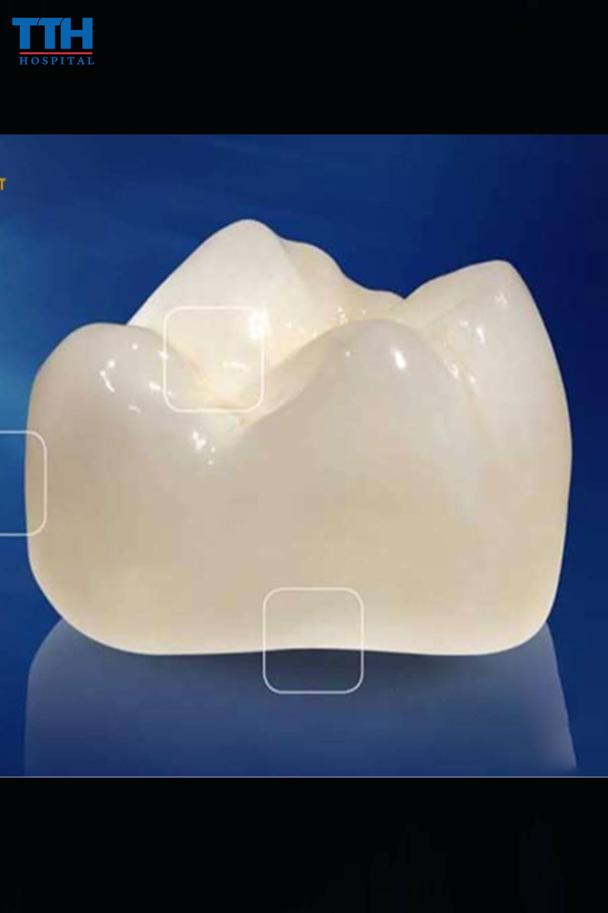 Răng Sứ Cercon tại Vinh Nghệ An