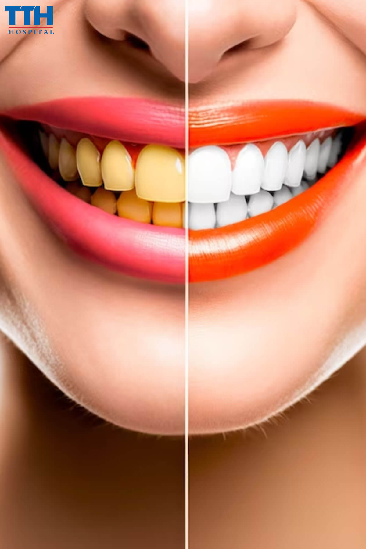 Nguyên Nhân Thay Đổi Màu Sắc Răng Sứ