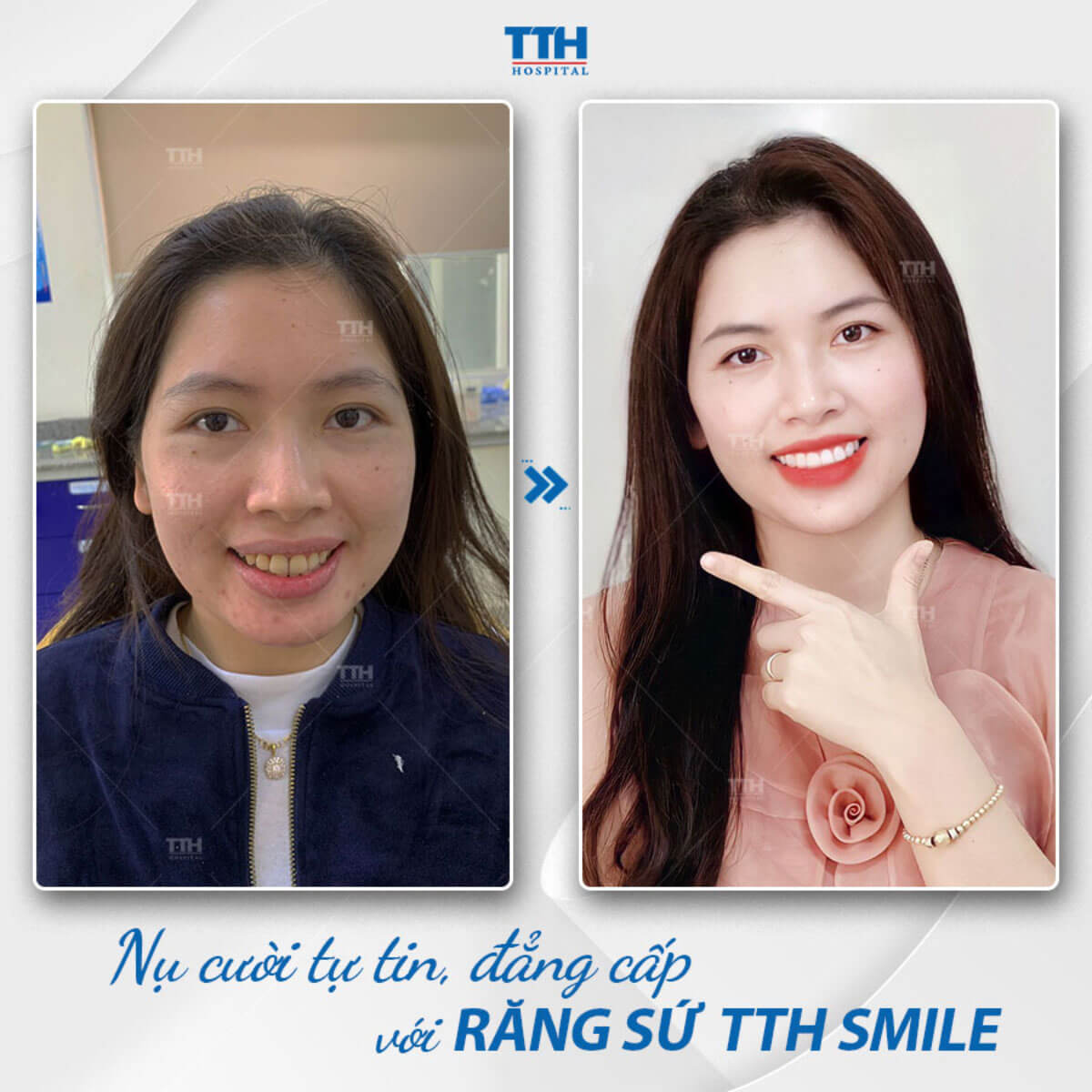 Răng sứ dùng để làm gì? Răng sứ tại vinh nghệ an