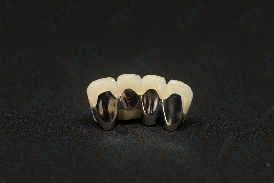 Răng Sứ Kim Loại - Giải pháp kinh tế