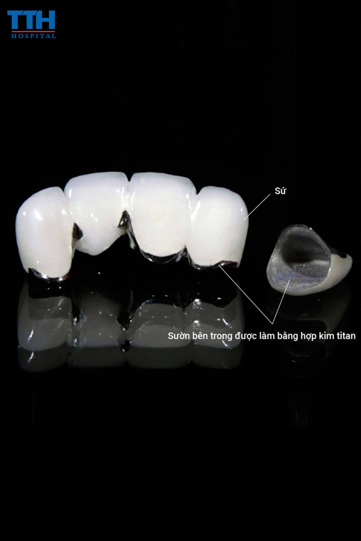 Răng sứ Titan tại Vinh, Nghệ An