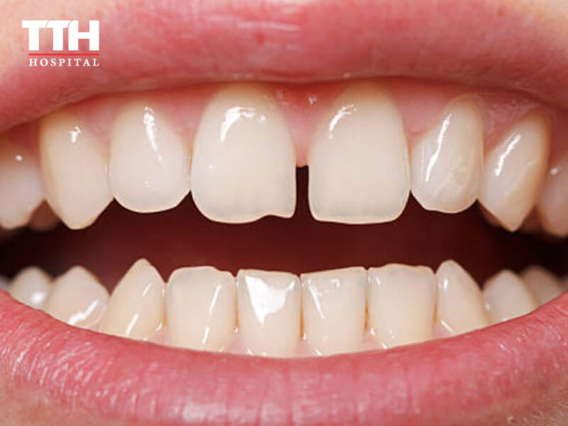 RĂNG THƯA (GAPPY TEETH)