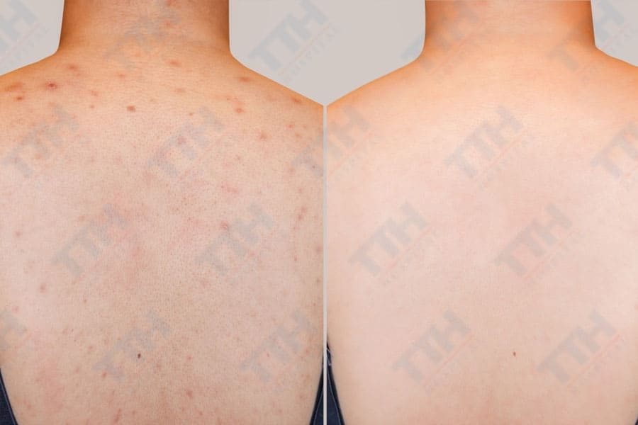 Sử dụng các phương pháp điều trị mụn lưng chuyên sâu