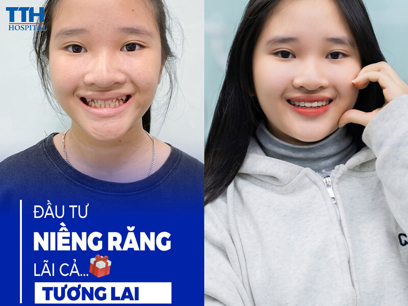 Tái Khám Định Kỳ Đúng Lịch Với Bác Sĩ Chỉnh Nha
