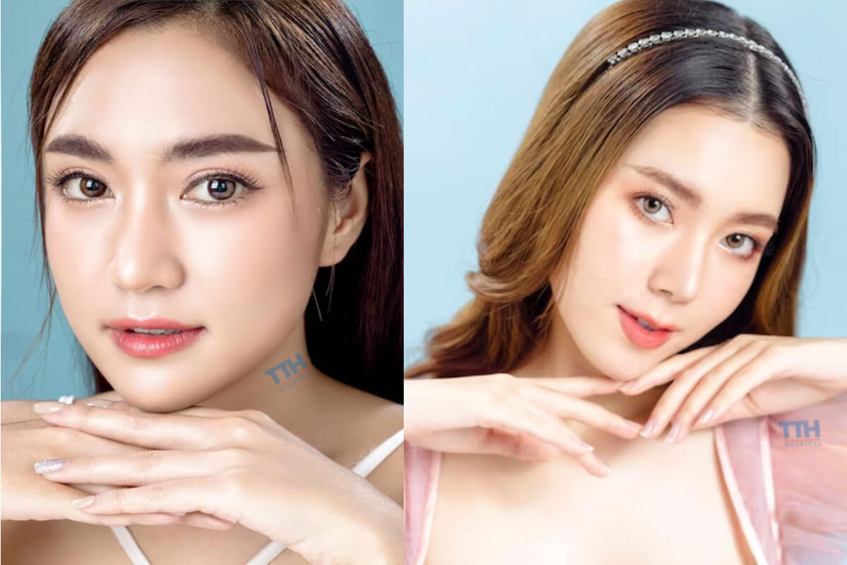 Nhiều người chọn bệnh viện Thái Thượng Hoàng để cắt mí tại Vinh
