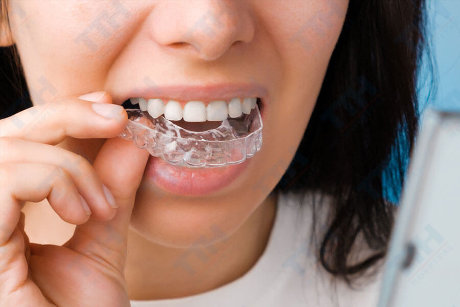 Tại sao răng có thể dịch chuyển sau khi tháo niềng?
