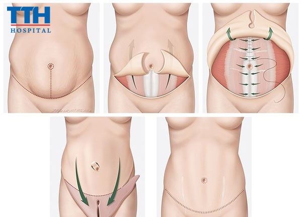 Hiểu thế nào là tạo hình thành bụng