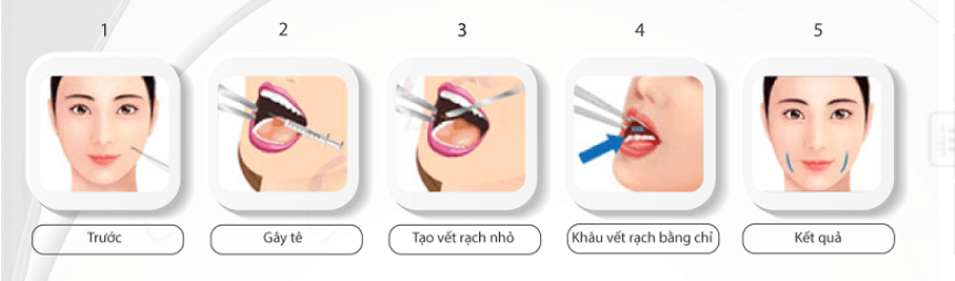 Ưu điểm của phương pháp tạo má lúm đồng tiền ?