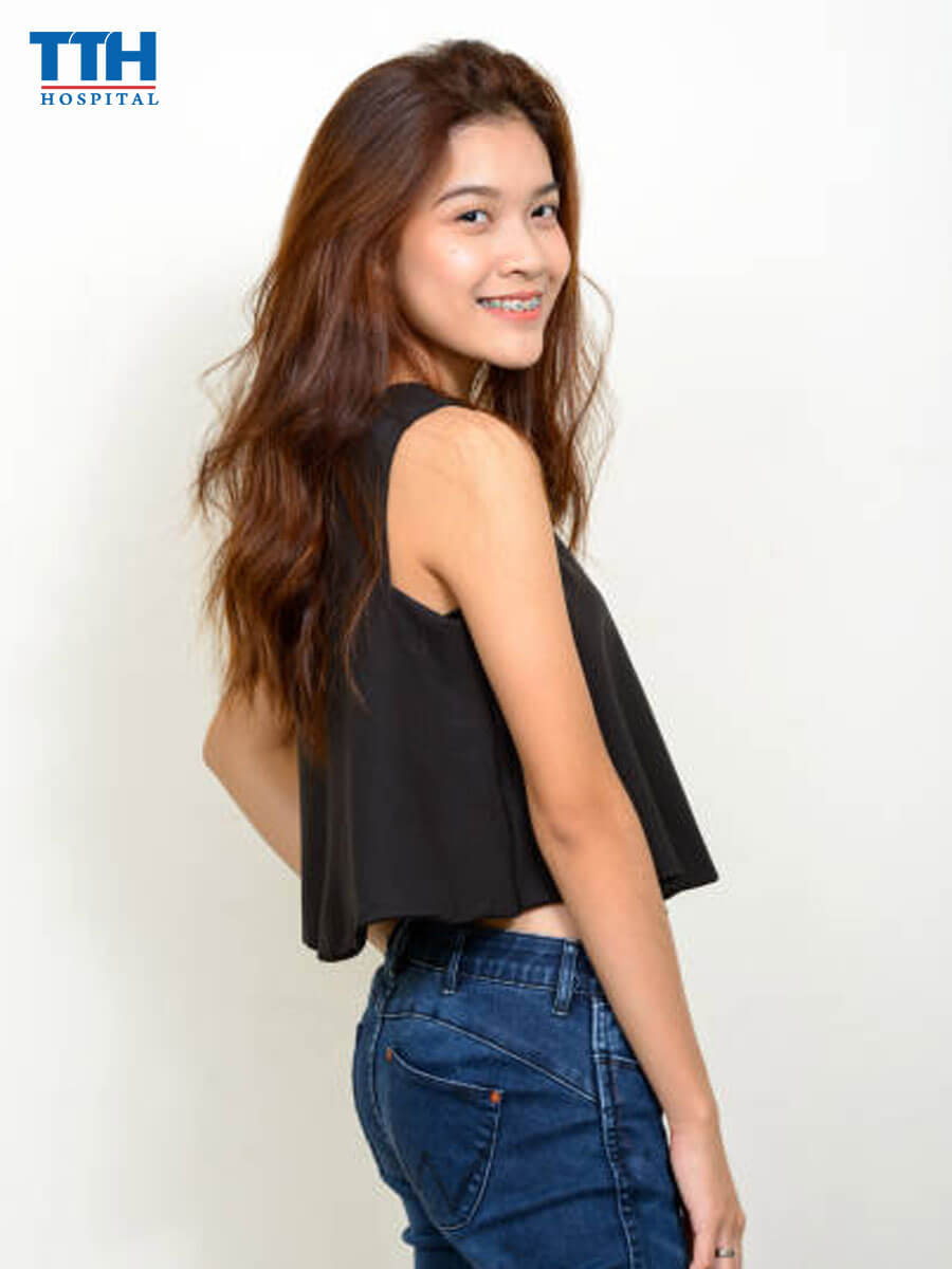 Thời Gian Niềng Răng Thưa