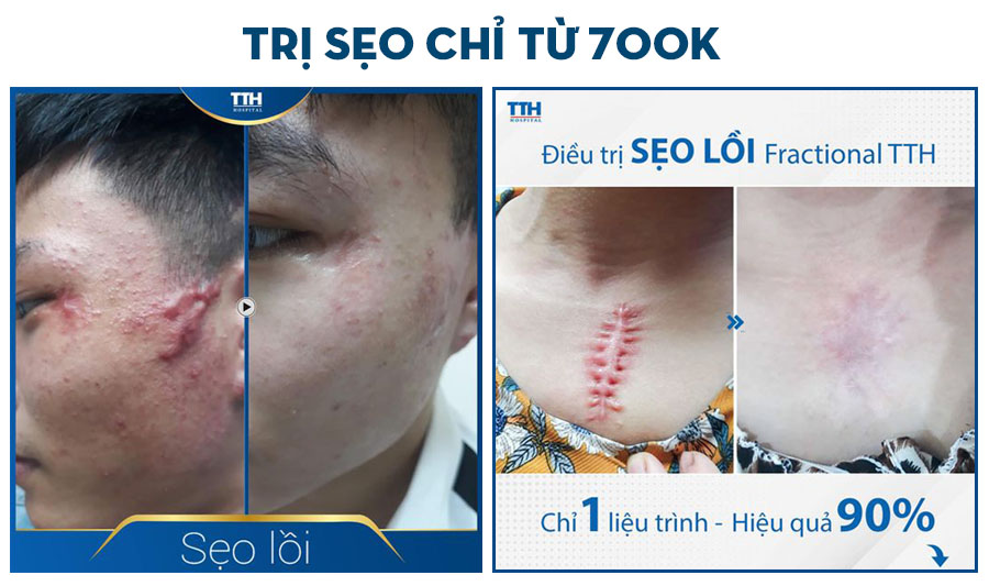 Trị sẹo chỉ từ 700K