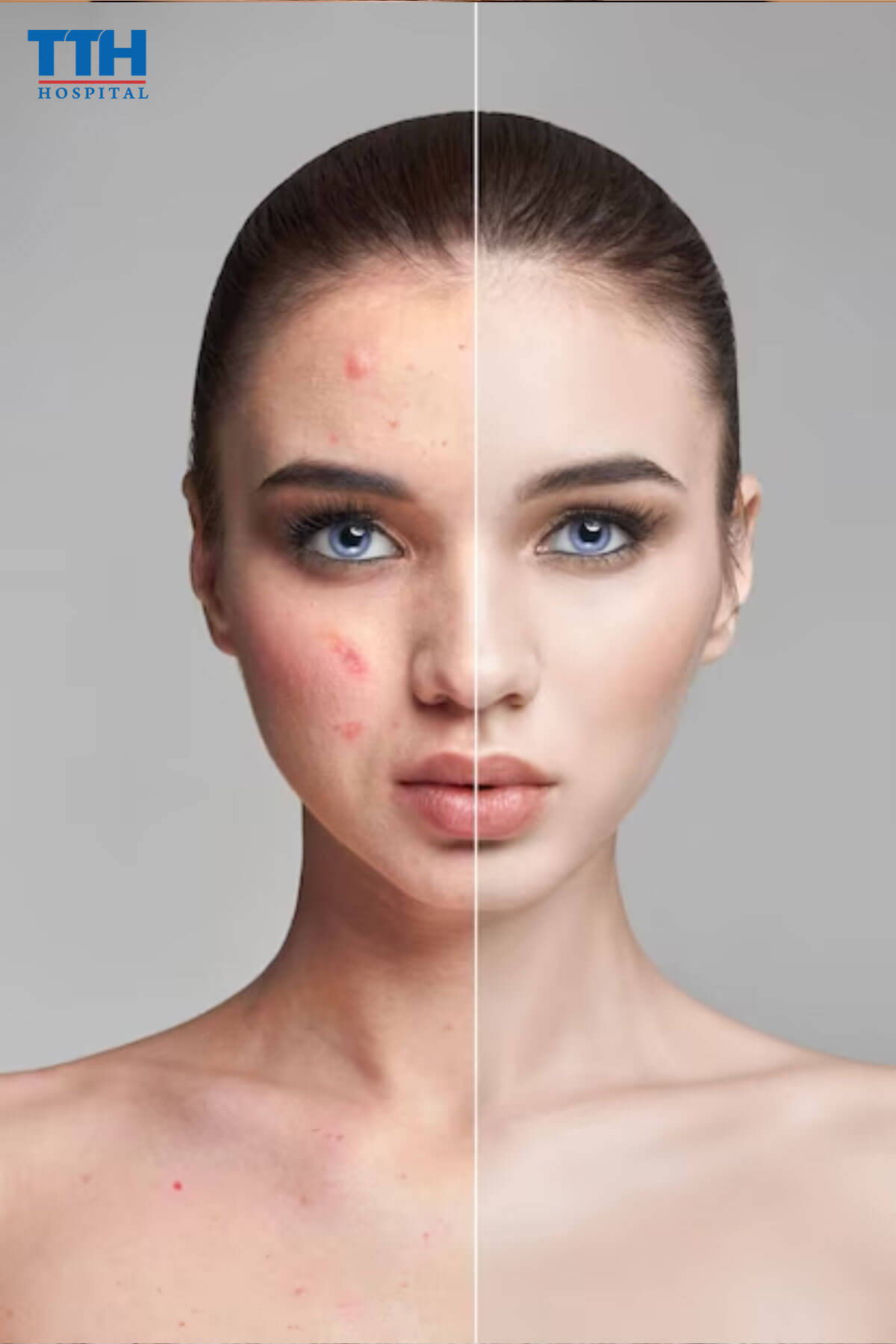 Triệu chứng của mụn tuổi dậy thì tại Vinh, nghệ an