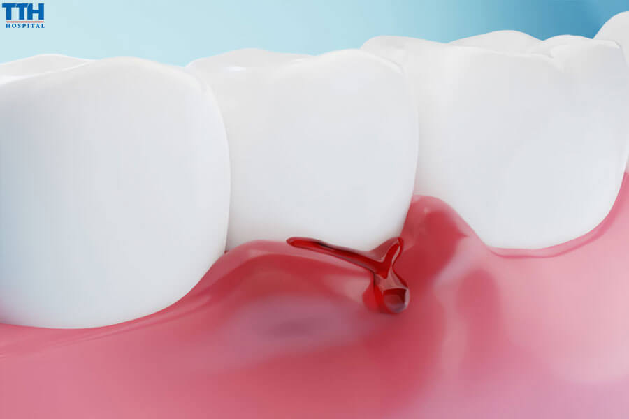 Triệu Chứng Của Viêm Tủy Răng Mãn Tính