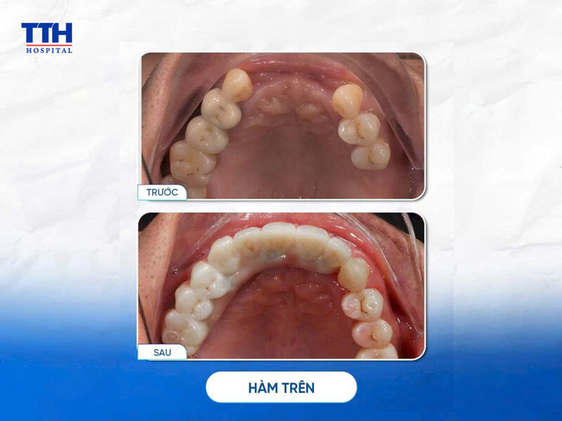 TRỒNG RĂNG IMPLANT M3 PHÙ HỢP VỚI NHỮNG AI?
