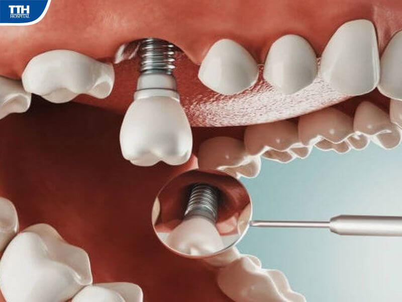 Trồng răng implant tại Bệnh viện Thái Thượng Hoàng