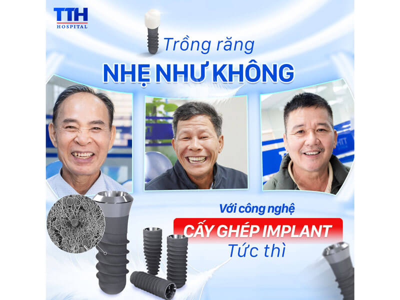 Trồng răng Implant Thái Thượng Hoàng – Giải pháp phục hồi răng mất an toàn và uy tín
