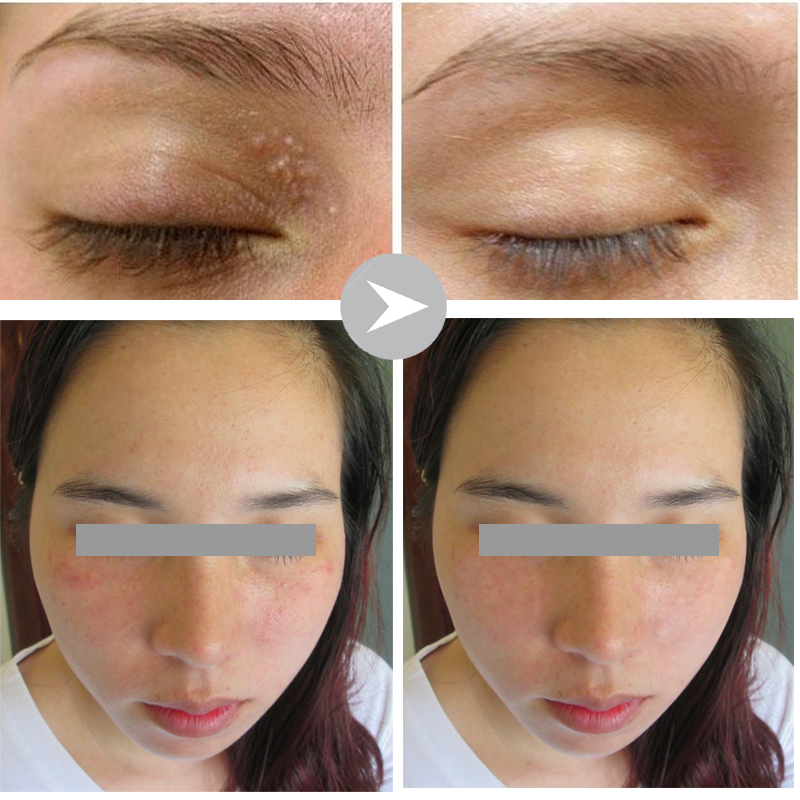 Điều trị mụn thịt