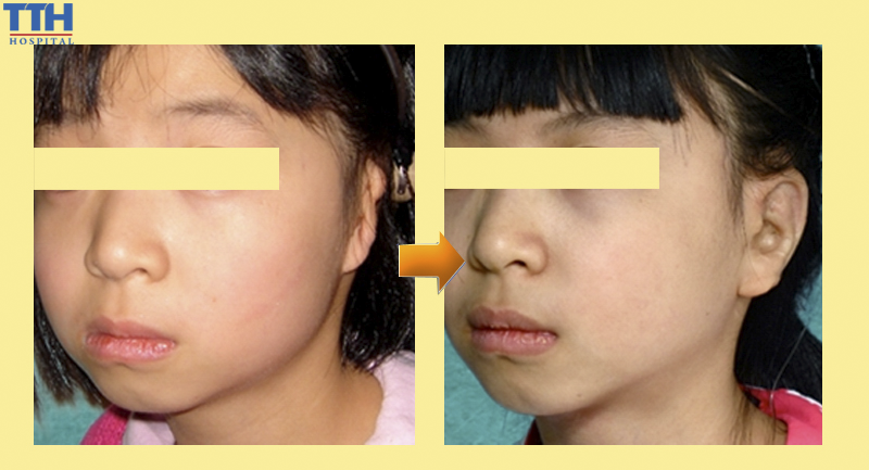 Hình ảnh trước và sau khi thực hiện 2