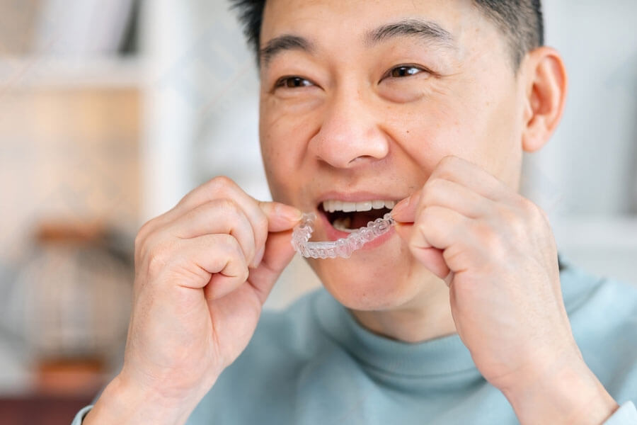 TTH Aligners là gì?