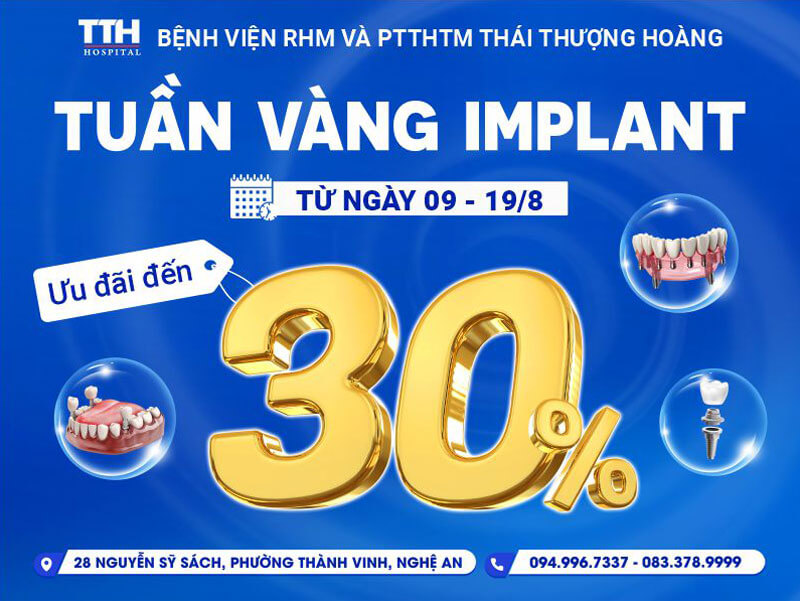Tháng 8 Rực Rỡ – Tuần Vàng Implant Tại Bệnh Viện Thái Thượng Hoàng
