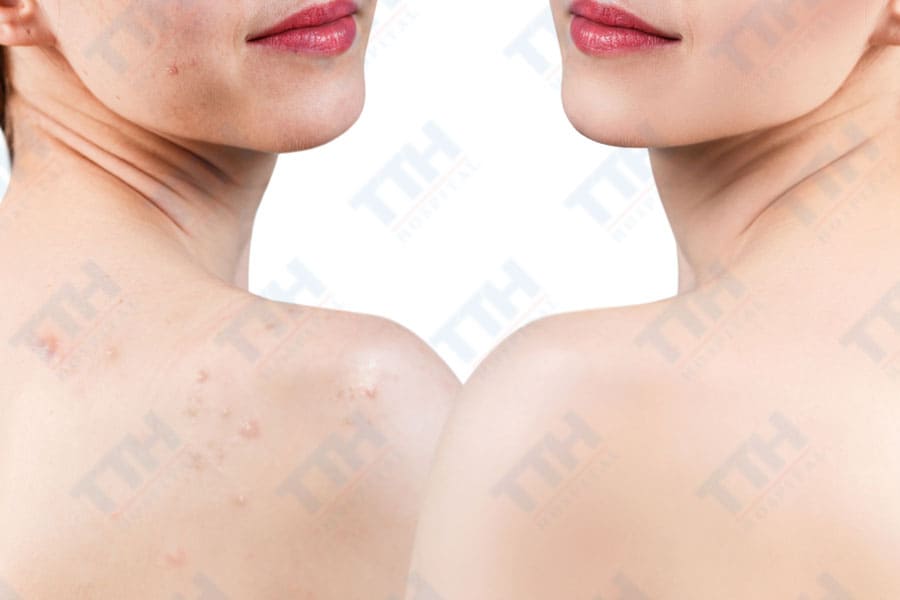 Ưu điểm của phương pháp điều trị mụn lưng bằng IPL kết hợp Oxy Jet aqua peel