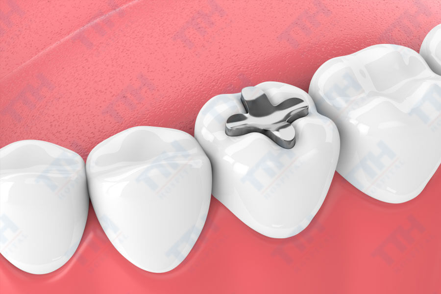 Ưu điểm của phương pháp điều trị sâu răng bằng SDF