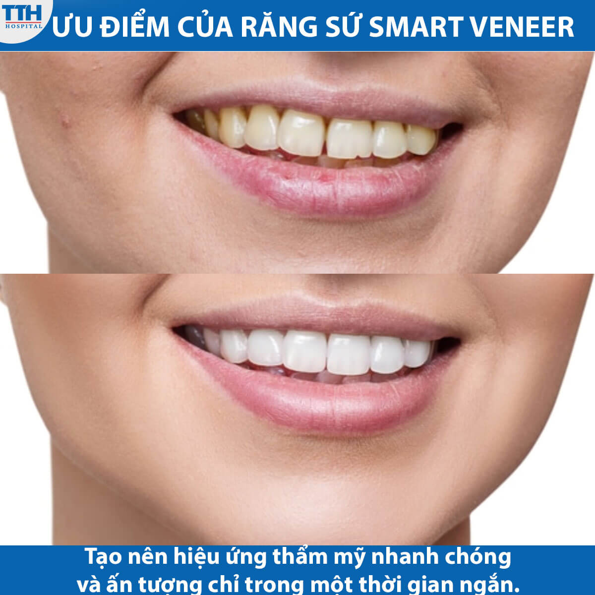 Răng sứ Smart Veneer là một giải pháp thẩm mỹ tối ưu để tạo nên một nụ cười hoàn hảo và tự tin.