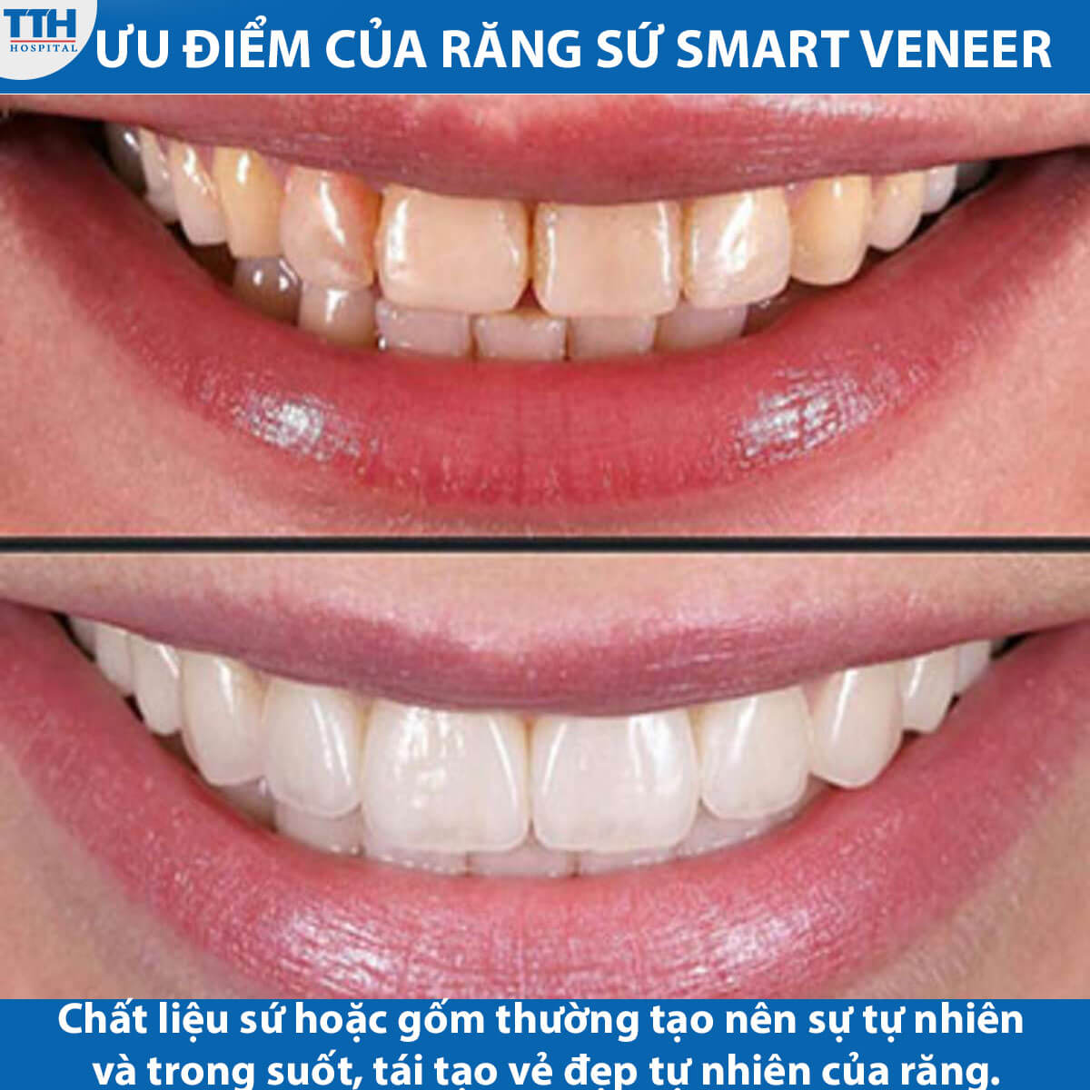 Ưu điểm của răng sứ Smart Veneer