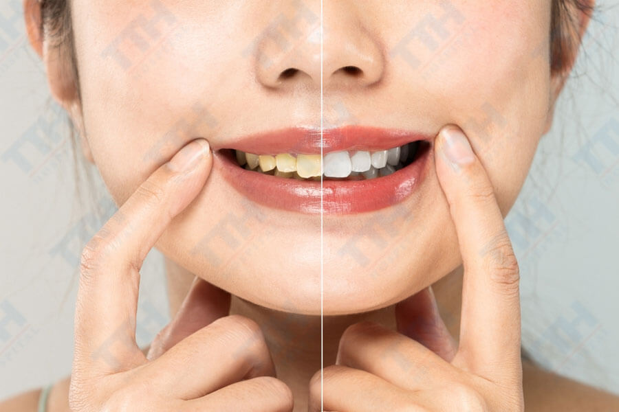 Ưu Điểm Của Răng Sứ Zirconia + Noritake