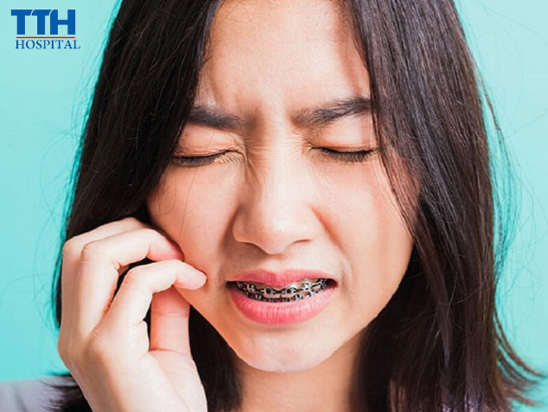 Vì Sao Cần Vệ Sinh Răng Miệng Cẩn Thận Khi Niềng Răng?
