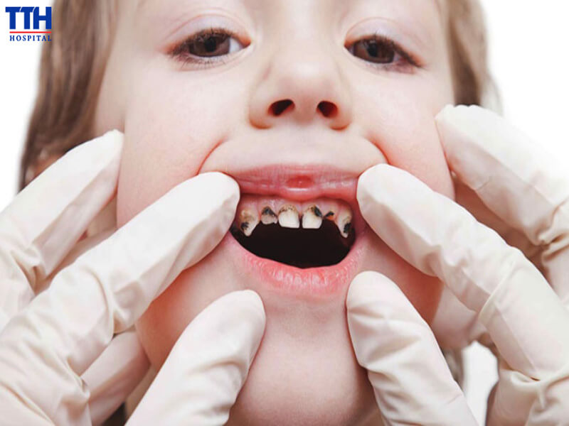 Vì sao nên áp dụng gây mê khi điều trị răng cho trẻ nhỏ?