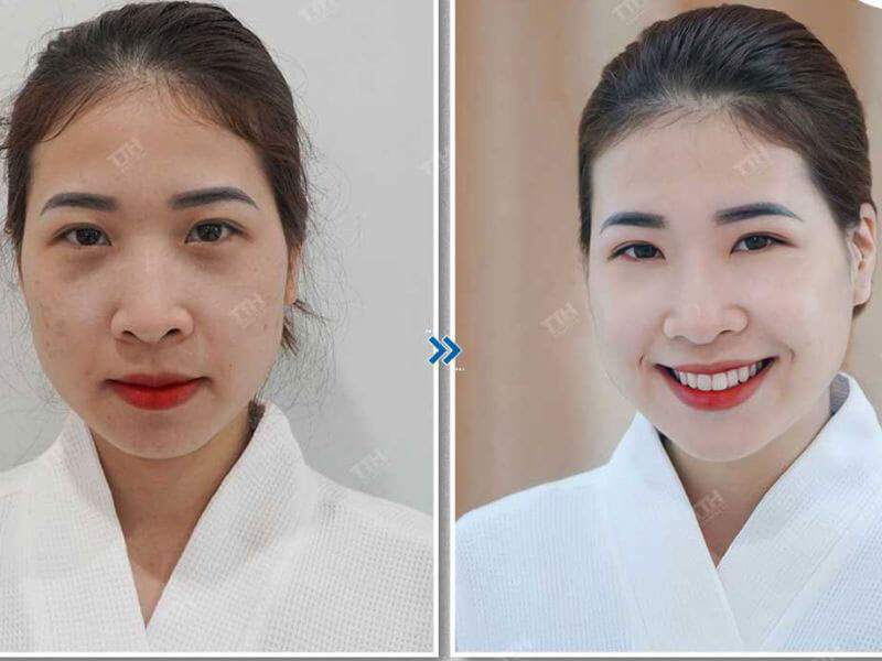 Trẻ hóa làn da vào mùa thu có lợi ích gì?