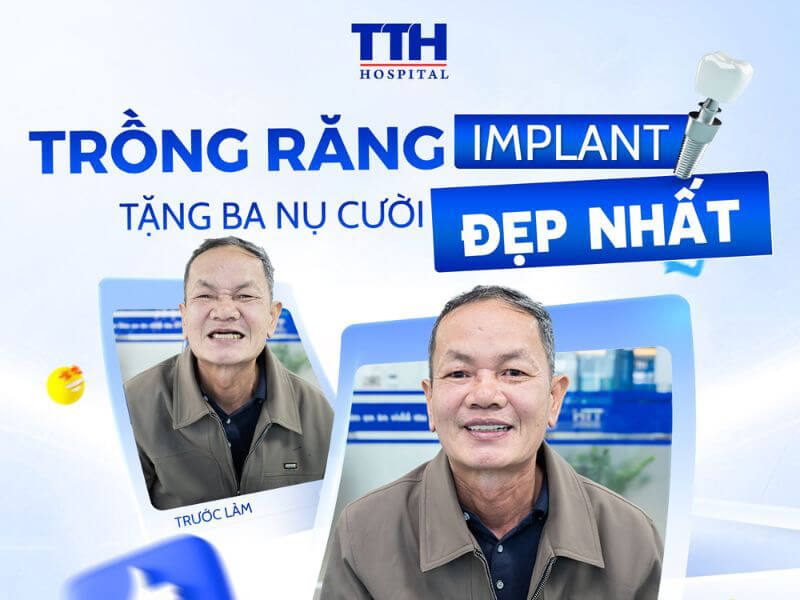 Vì sao trồng răng Implant được ví như “nhẹ như không”?