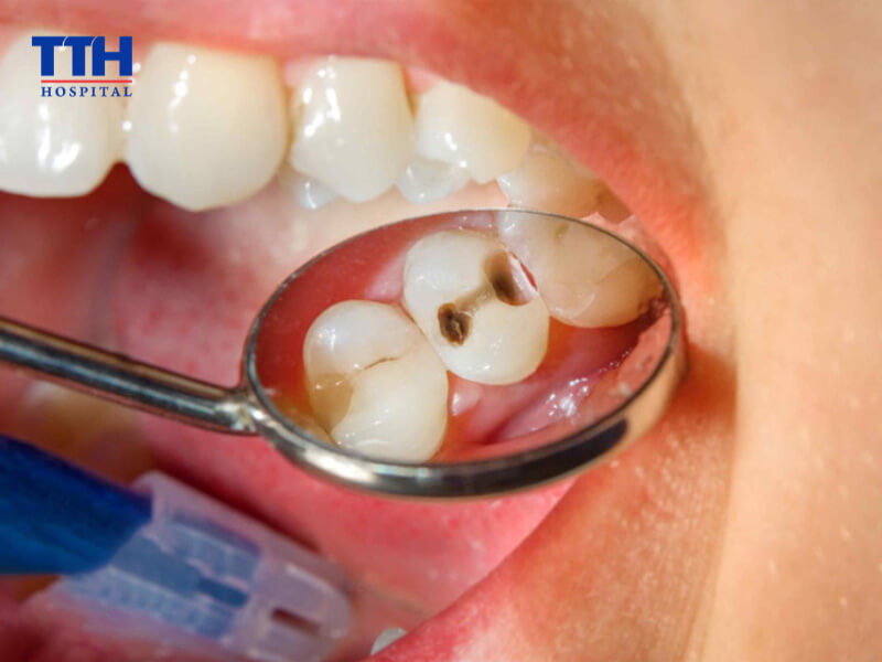 Viêm tủy răng có thể gây hoại tử và mất răng