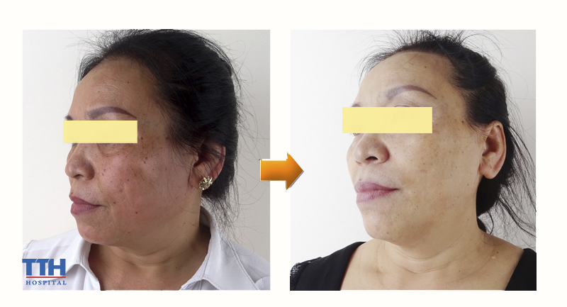 Nâng cơ, trẻ hóa da Hifu