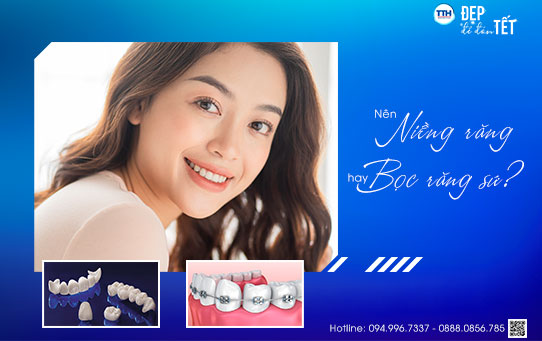 Nên niềng răng hay bọc răng sứ?