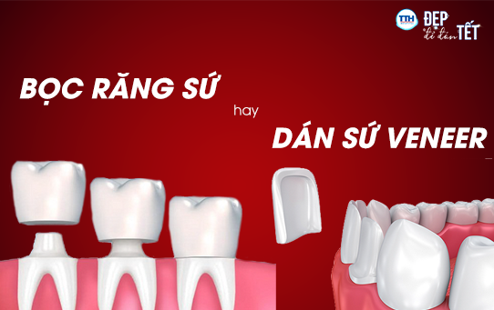 Nên bọc răng sứ hay dán sứ Veneer? Răng sứ thẩm mỹ uy tín tại Nghệ An