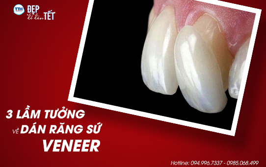 Top 3 lầm tưởng thường gặp về dán răng sứ Veneer