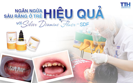 Ngăn ngừa sâu răng hiệu quả ở trẻ em bằng Silver Diamine Fluor - SDF