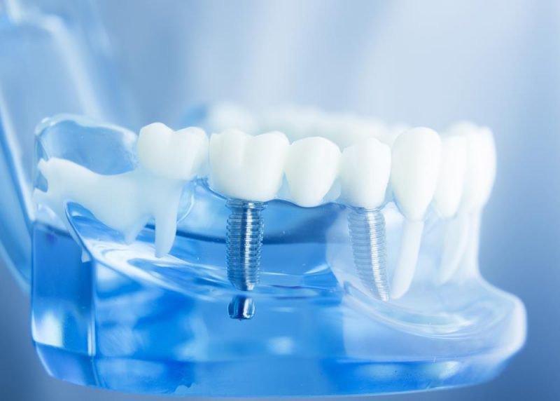 Cắm ghép Implant