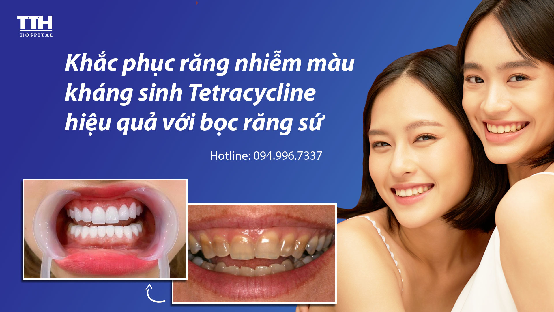Khắc phục răng nhiễm màu kháng sinh Tetracycline hiệu quả với bọc răng sứ